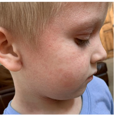 Beckett's moderate-to-severe atopic dermatitis on face at six years old