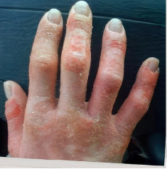 Jennifer's moderate-to-severe atopic dermatitis on hand at twenty years old