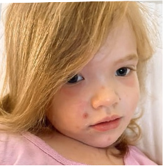 Lila's moderate-to-severe atopic dermatitis on face at three and a half years old