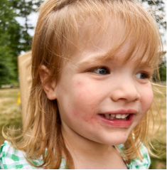 Lila's moderate-to-severe atopic dermatitis on face at three years old