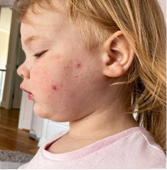 Lila's moderate-to-severe atopic dermatitis on face at two years old