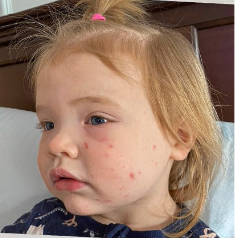 Lila's moderate-to-severe atopic dermatitis on face at two years old