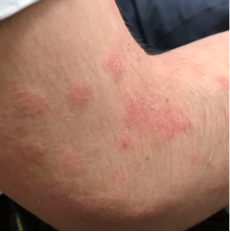 Tyler's moderate-to-severe atopic dermatitis at eight years old