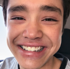 Tyler's moderate-to-severe atopic dermatitis on face at twelve years old