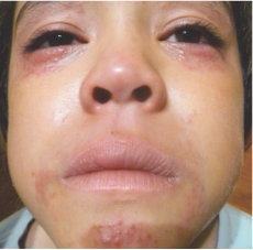 Tyler's moderate-to-severe atopic dermatitis on face at eight years old