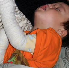 Tyler's moderate-to-severe atopic dermatitis at two years old