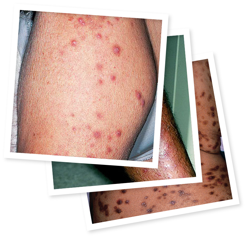 Pictures of prurigo nodularis