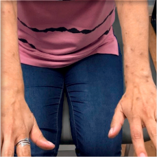 Prurigo nodularis on arms of a 39 year old patient