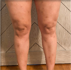 Prurigo nodularis on legs of a 39 year old patient