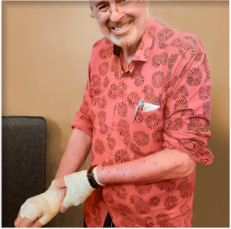 A 70 year old male prurigo nodularis patient wearing gloves to cover the nodules on his hands