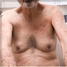 Prurigo nodularis on arms and chest of a 70 year old patient