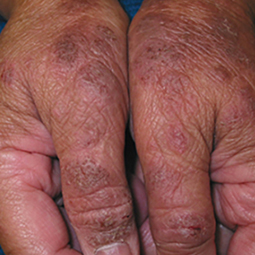Moderate-to-Severe eczema on dark, brown, black skin on hands
