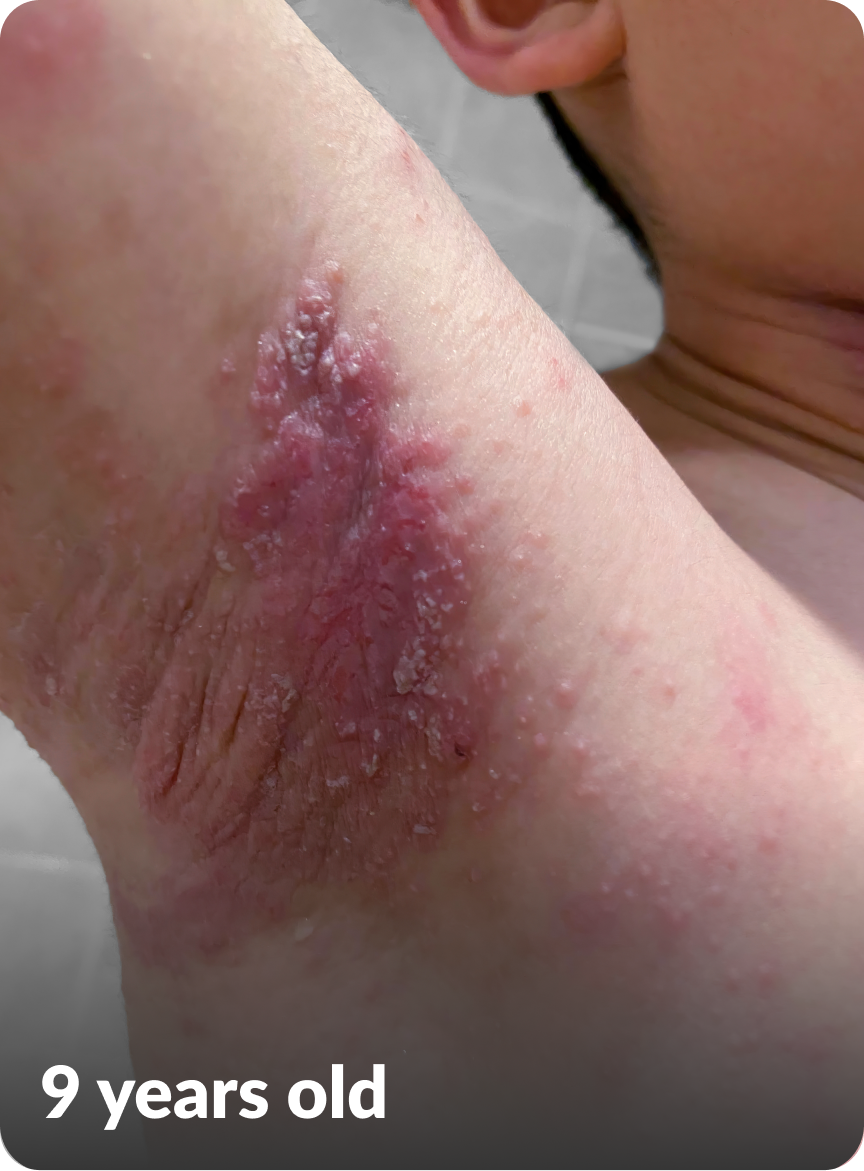 Kayden's moderate-to-severe atopic dermatitis on wrist at nine years old