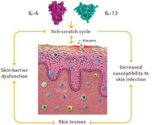 Diagram of the itch scratch cycle caused by type 2 inflammation that plays a key role in atopic dermatitis