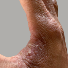 Cat's moderate-to-severe atopic dermatitis on foot at thirty six years old