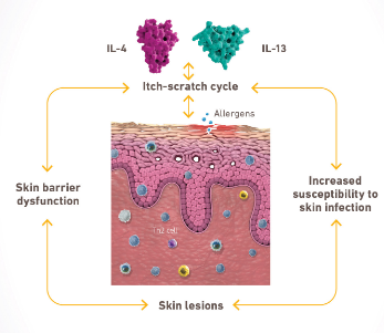 Diagram of the itch scratch cycle caused by type 2 inflammation that plays a key role in atopic dermatitis