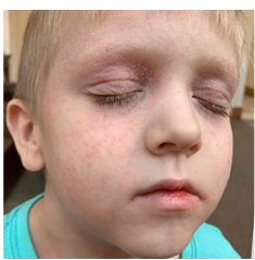 Beckett's moderate-to-severe atopic dermatitis on face at six years old 