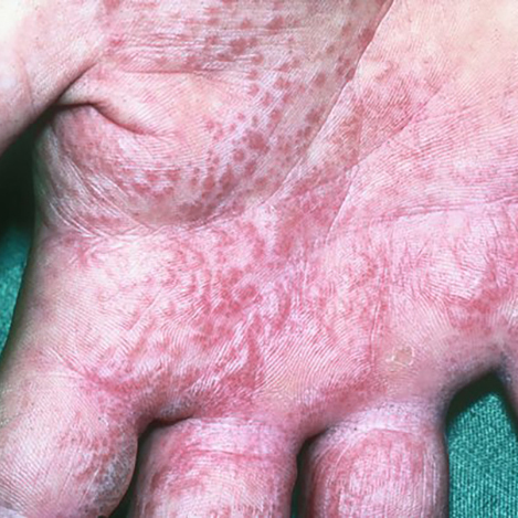 Moderate-to-Severe eczema on light, white, pale, fair skin on hand