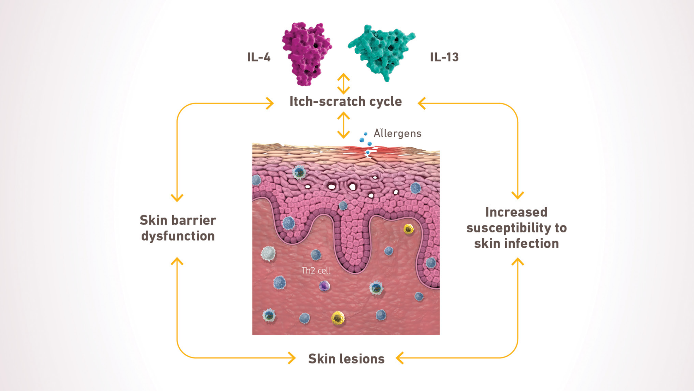Diagram of the itch scratch cycle caused by type 2 inflammation that plays a key role in atopic dermatitis