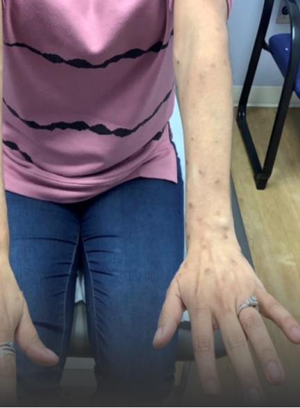 Prurigo nodularis on arms of a 39 year old patient