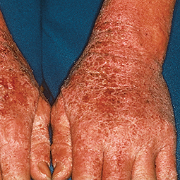 Moderate-to-Severe eczema on dark, brown, black skin on hands