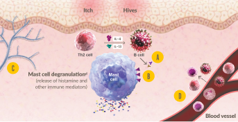Diagram demonstrating how type 2 inflammation may contribute to disease chronicity in CSU