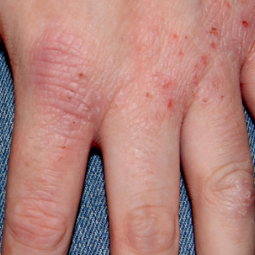 Moderate-to-Severe eczema on light, white, pale, fair skin on hand
