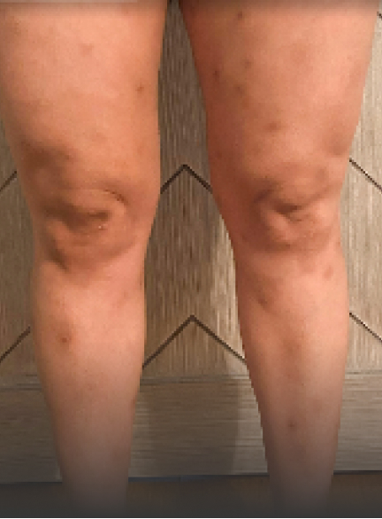 Prurigo nodularis on legs of a 39 year old patient