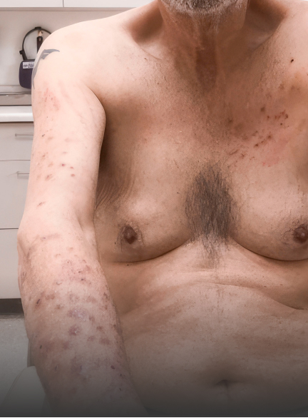 Prurigo nodularis on arms and chest of a 70 year old patient