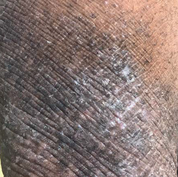 Moderate-to-Severe eczema on dark, brown, black skin on leg