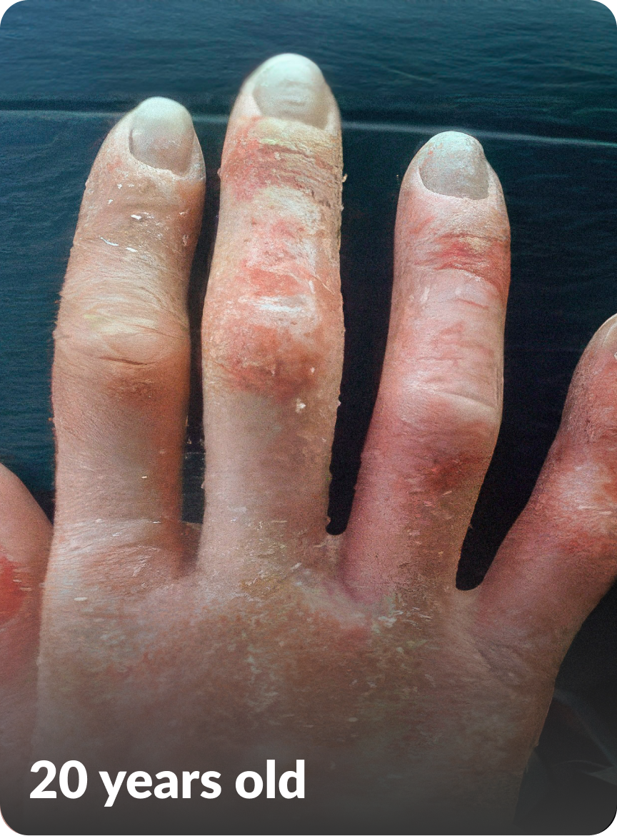Jennifer's moderate-to-severe atopic dermatitis on hand at twenty years old