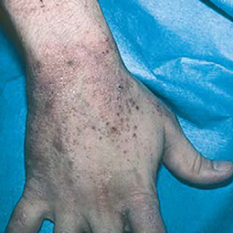 Moderate-to-Severe eczema on light, white, pale, fair skin on hand