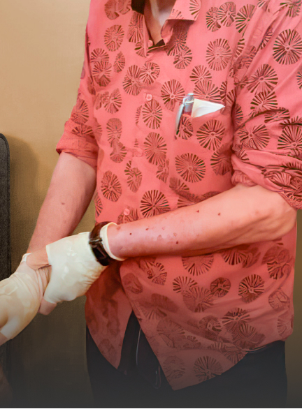 A 70 year old male prurigo nodularis patient wearing gloves to cover the nodules on his hands
