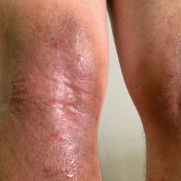 Moderate-to-Severe eczema on light, white, pale, fair skin on legs