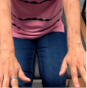 Jennifer before Dupixent