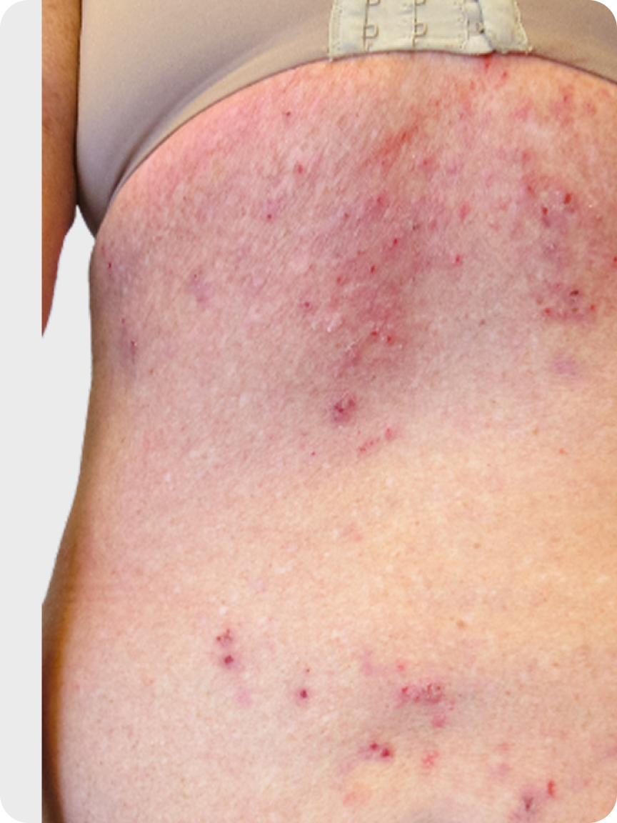 Prurigo nodularis on a female patient's back