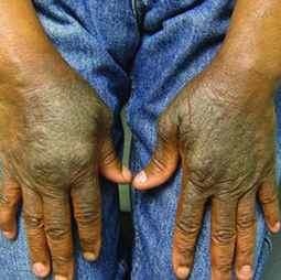 Moderate-to-Severe eczema on dark, brown, black skin on hands