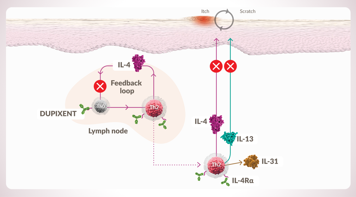 Diagram of Dupixent® (dupilumab) inhibiting IL-4 and IL-13 signaling