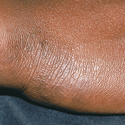 Moderate-to-Severe eczema on dark, brown, black skin on wrist