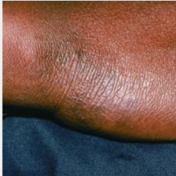 Moderate-to-Severe eczema on dark, brown, black skin on wrist