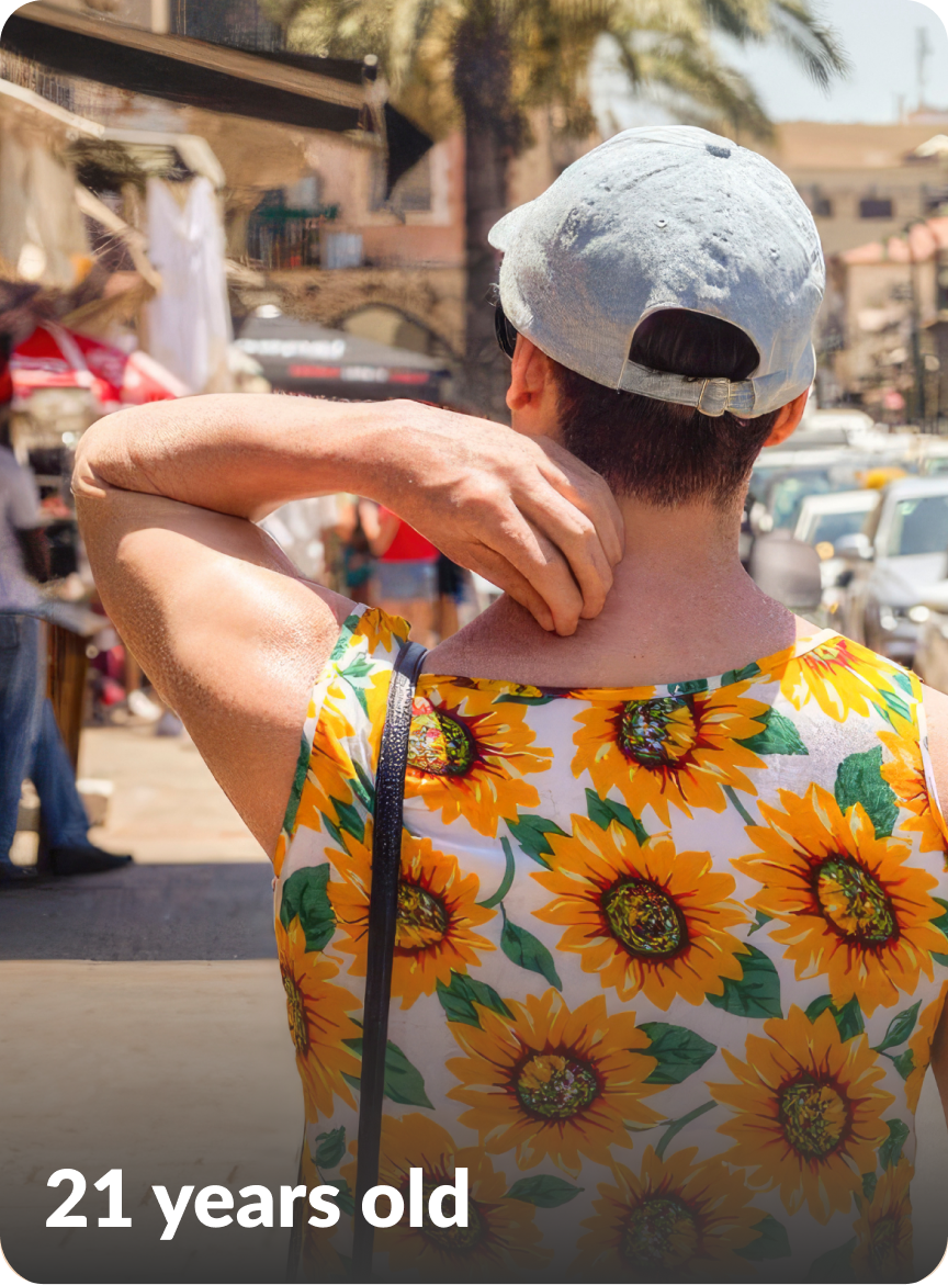 Paulo's moderate-to-severe atopic dermatitis on back at twenty one years old