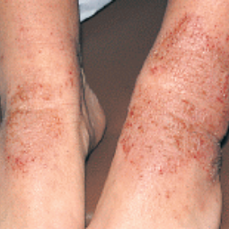 Moderate-to-Severe eczema on light, white, pale, fair skin on ankles