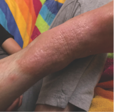 Tyler's moderate-to-severe atopic dermatitis on arm at eleven years old
