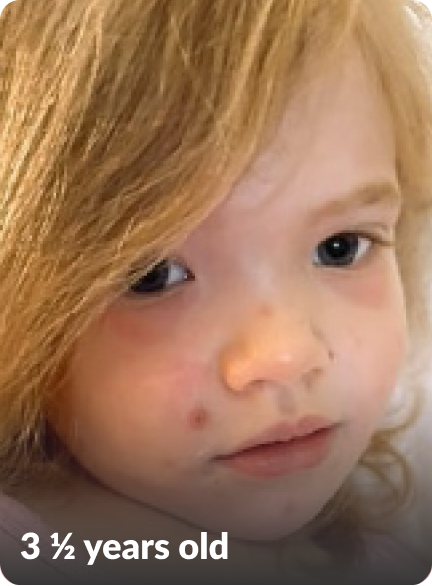 Lila's moderate-to-severe atopic dermatitis on face at three and a half years old