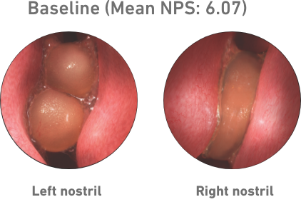 Nasal Polyps Score Improvements DUPIXENT dupilumab