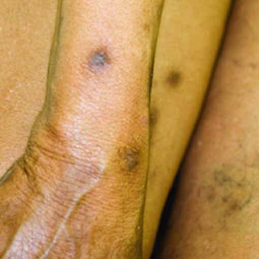 Prurigo nodularis (PN) on a patient's wrist, arm and leg who is not on DUPIXENT® (dupilumab)