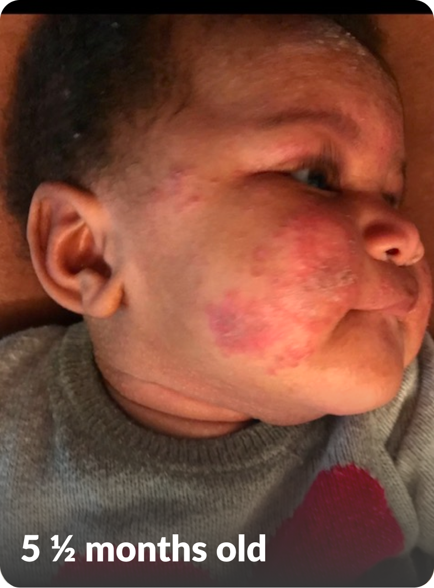 Bailey's moderate-to-severe atopic dermatitis on face at five and a half years old