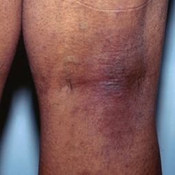 Moderate-to-Severe eczema on dark, brown, black skin on leg