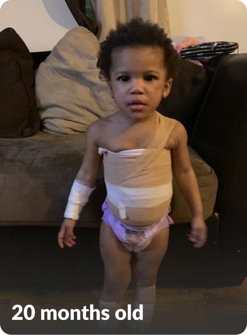 Bailey, a child with moderate-to-severe atopic dermatitis at 20 months old