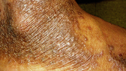 Moderate-to-Severe eczema on dark, brown, black skin on ankle